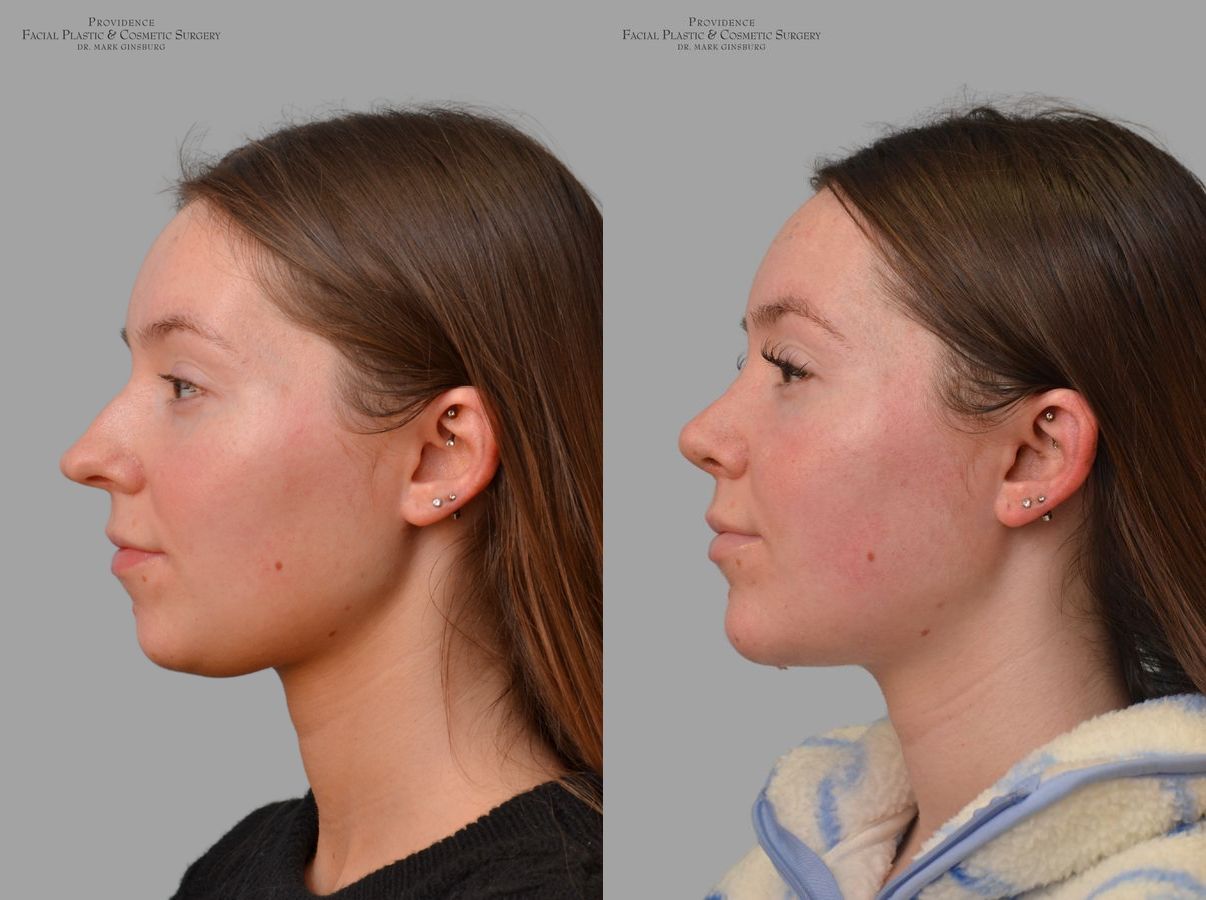 Before and after Primary Rhinoplasty case 43674