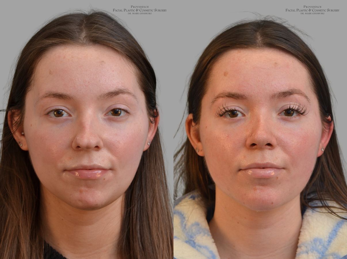 Before and after Primary Rhinoplasty case 43674 - Angle 3