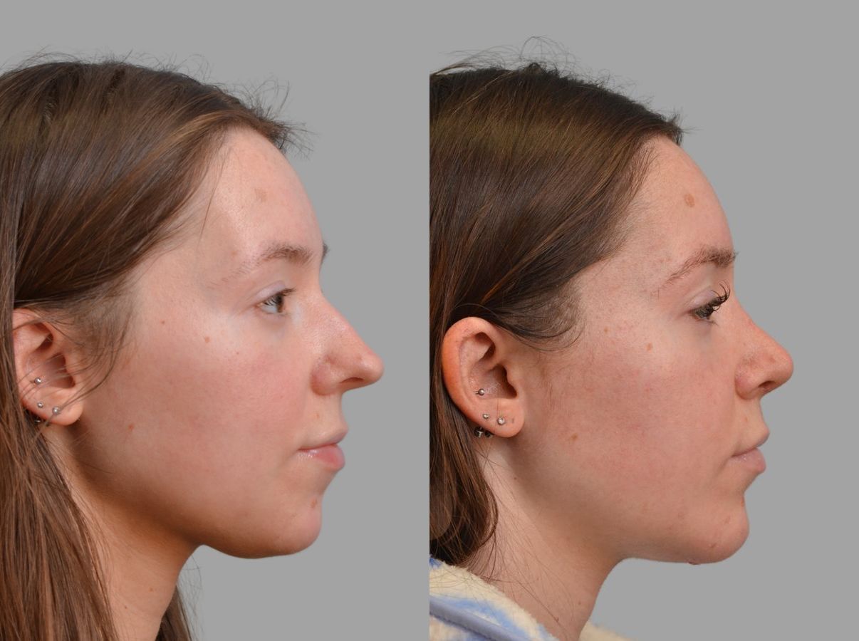 Before and after Primary Rhinoplasty case 43674 - Angle 7
