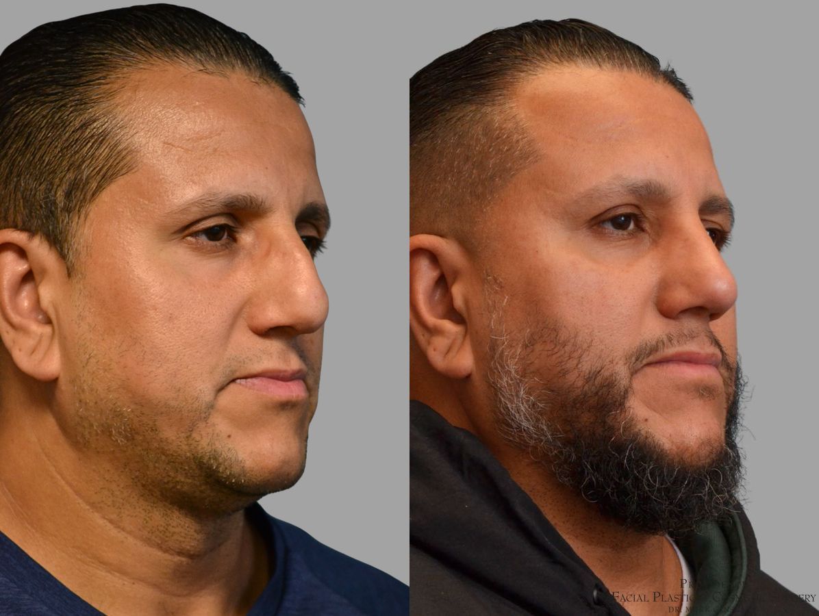Before and after Thick Skin Rhinoplasty case 45829 - Angle 2