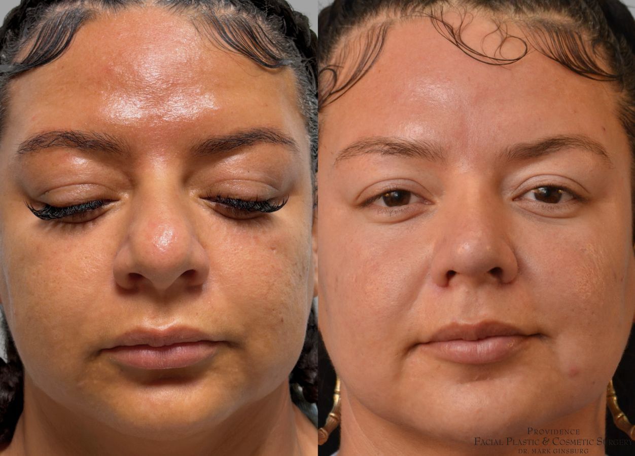 Before and after Ethnic Rhinoplasty case 43729 - Angle 3