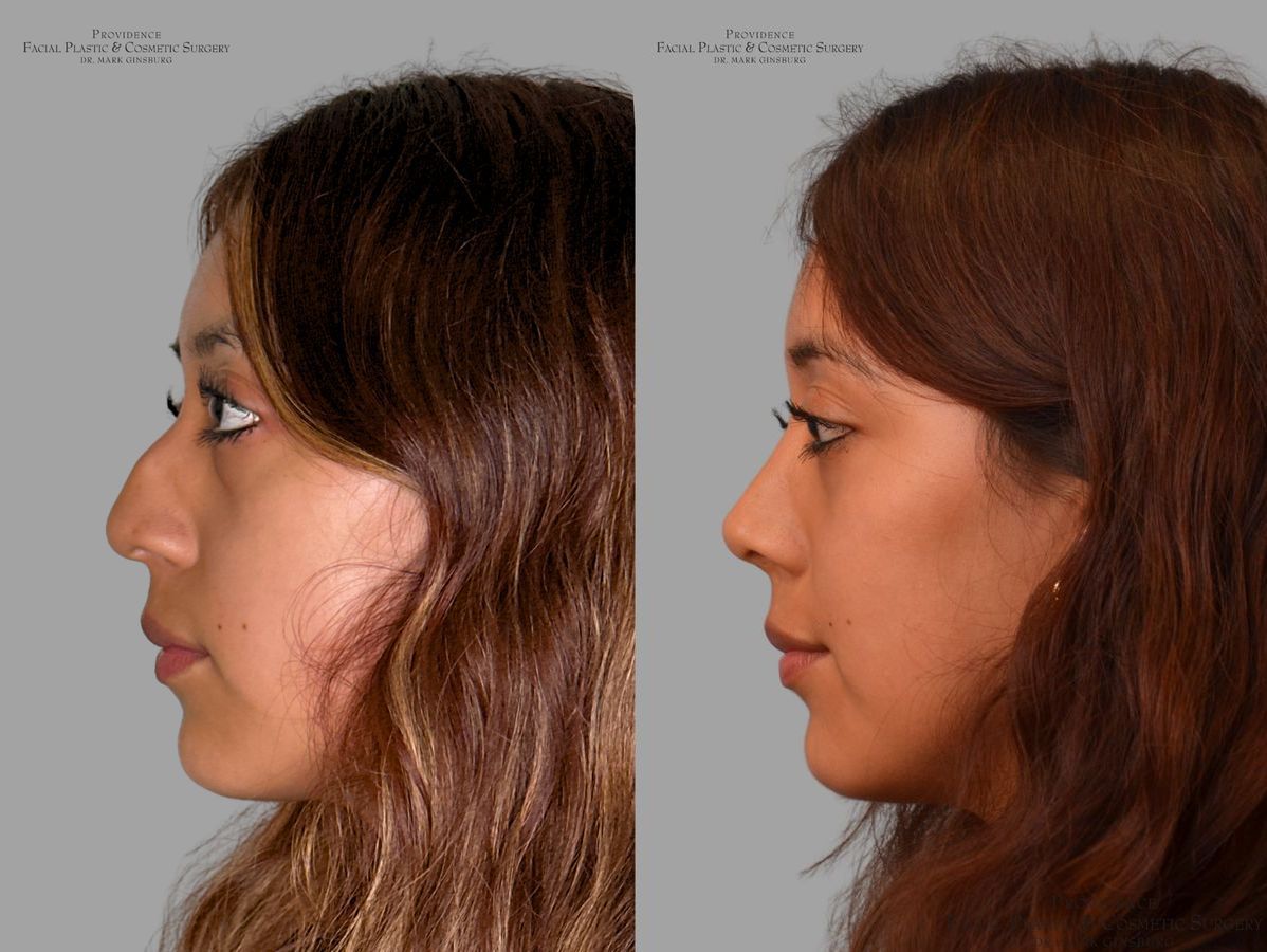 Before and after Primary Rhinoplasty case 43728