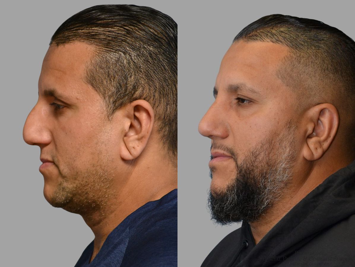 Before and after Thick Skin Rhinoplasty case 45829 - Angle 5