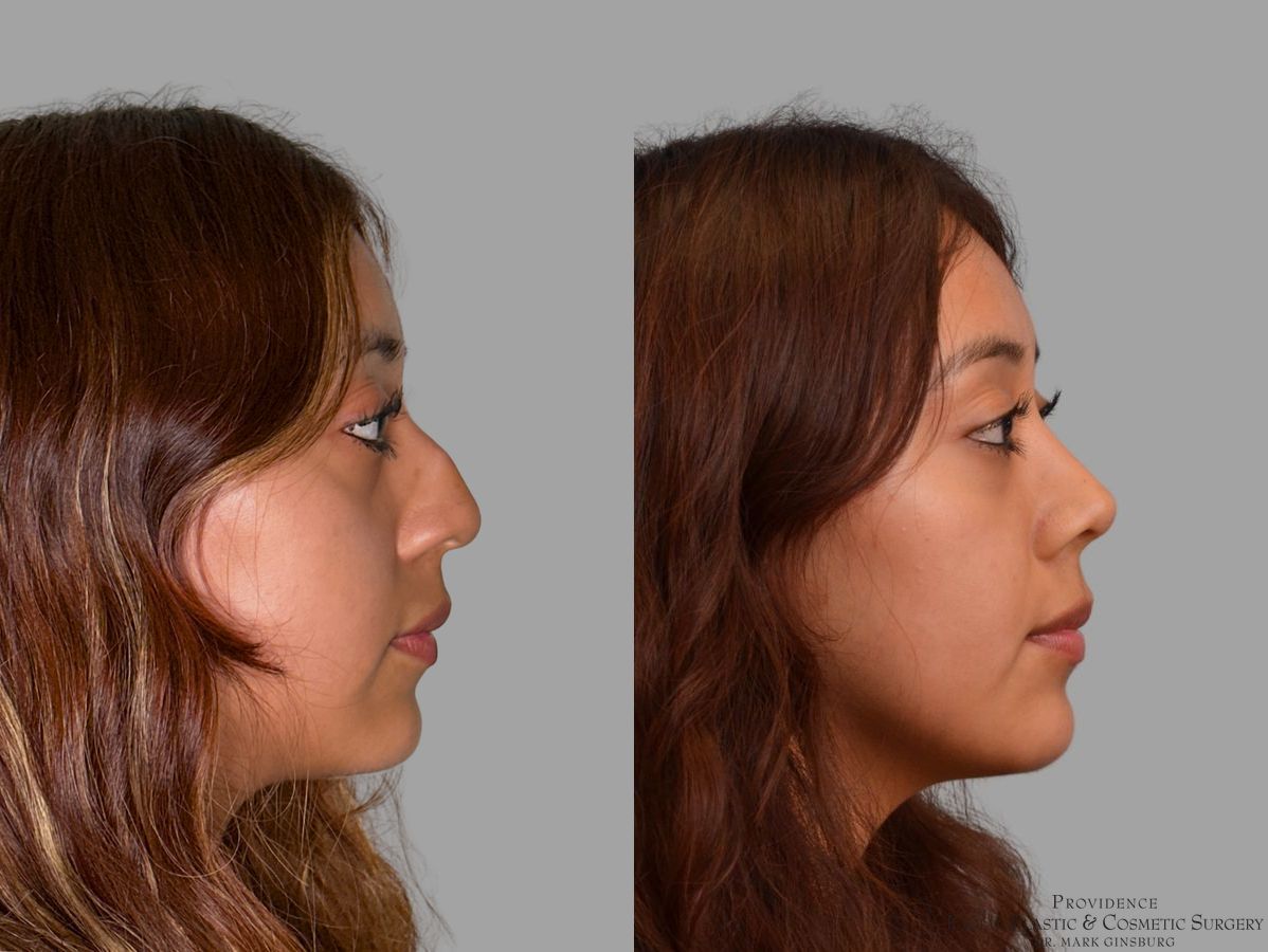 Before and after Primary Rhinoplasty case 43728 - Angle 5