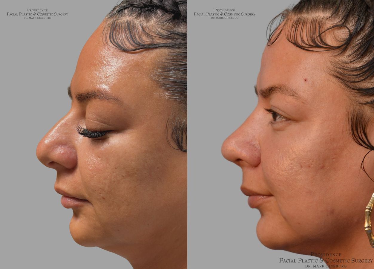 Before and after Ethnic Rhinoplasty case 43729