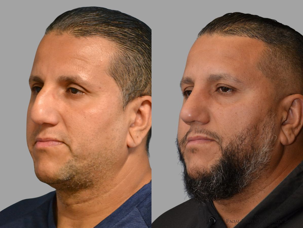 Before and after Thick Skin Rhinoplasty case 45829 - Angle 4