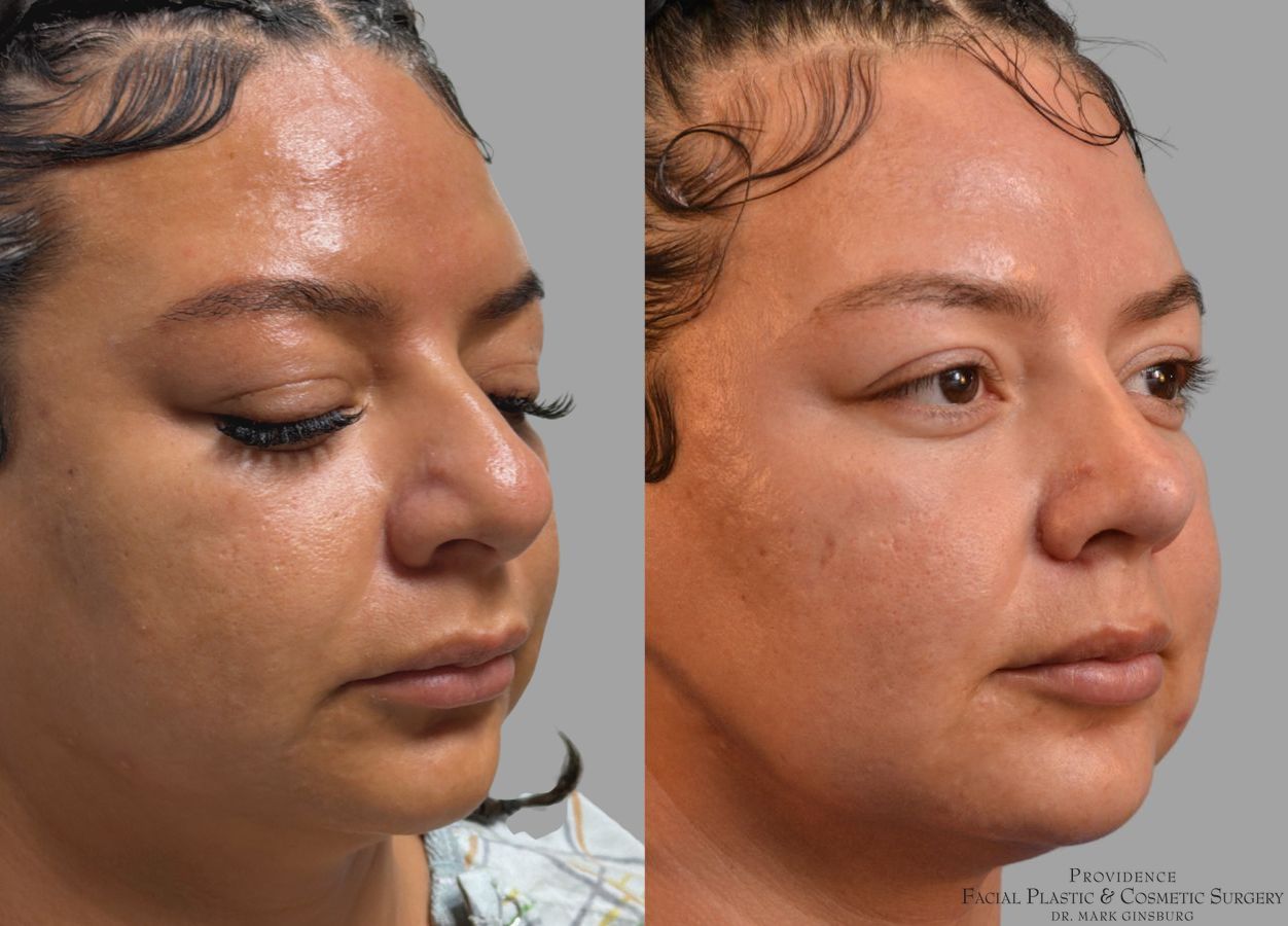 Before and after Ethnic Rhinoplasty case 43729 - Angle 4