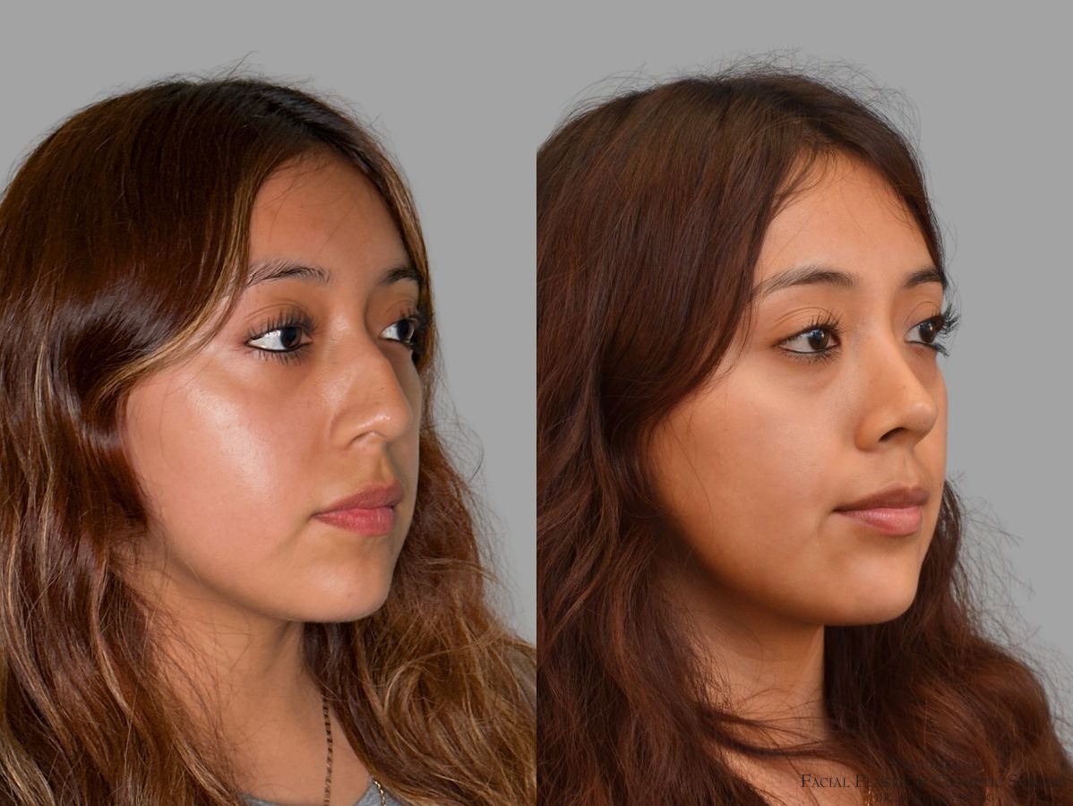 Before and after Primary Rhinoplasty case 43728 - Angle 4