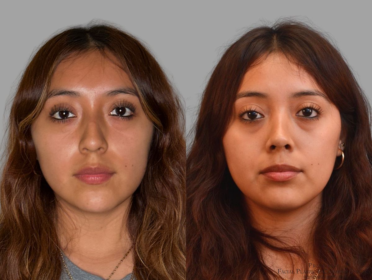 Before and after Primary Rhinoplasty case 43728 - Angle 3
