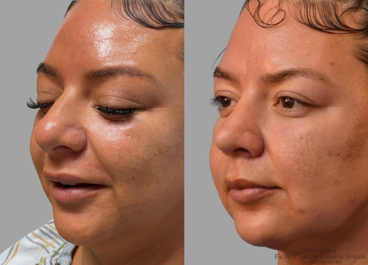 Before and after Ethnic Rhinoplasty case 43729 - Angle 2