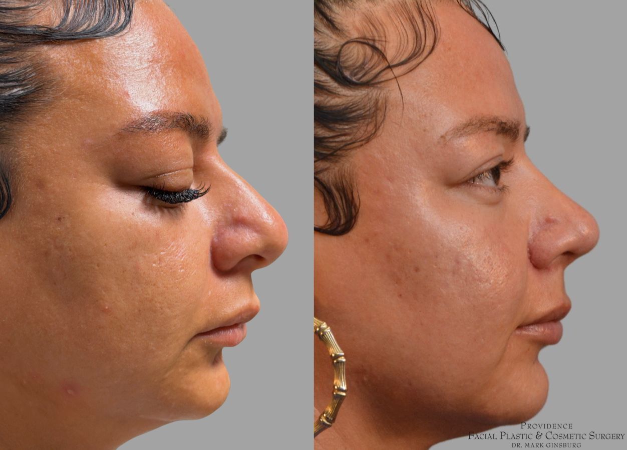 Before and after Ethnic Rhinoplasty case 43729 - Angle 5