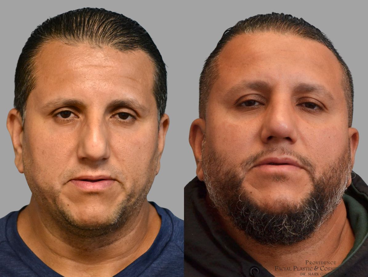 Before and after Thick Skin Rhinoplasty case 45829 - Angle 3