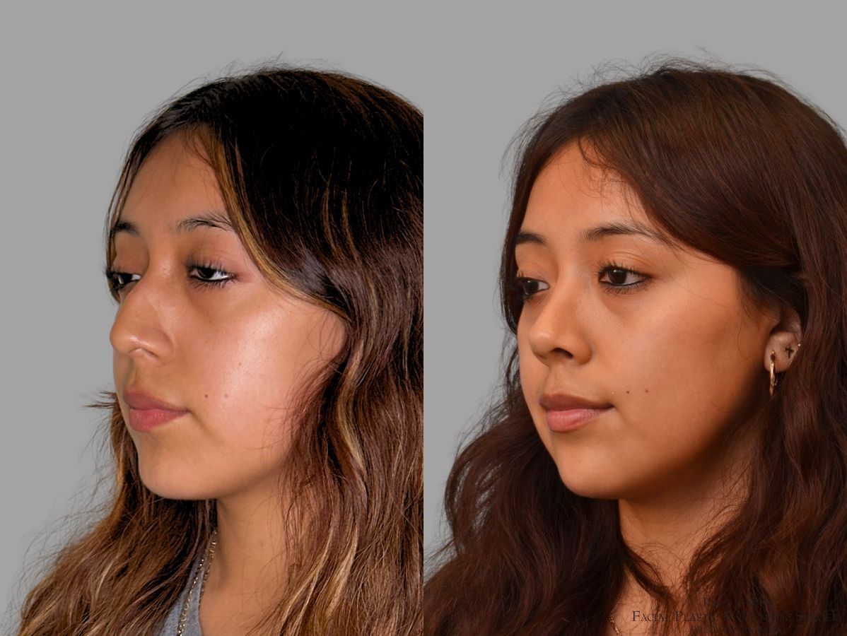 Before and after Primary Rhinoplasty case 43728 - Angle 2