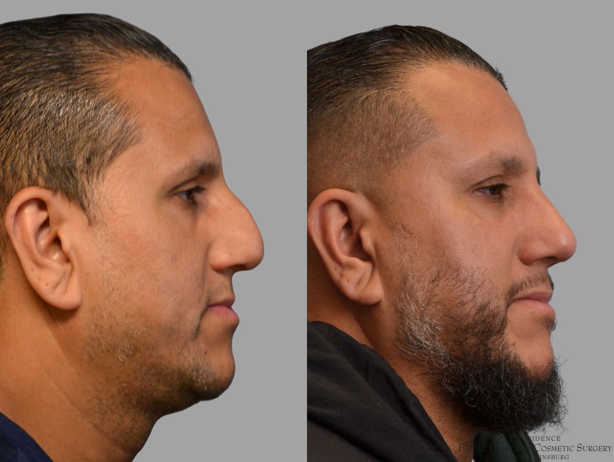 Before and after Thick Skin Rhinoplasty case 45829
