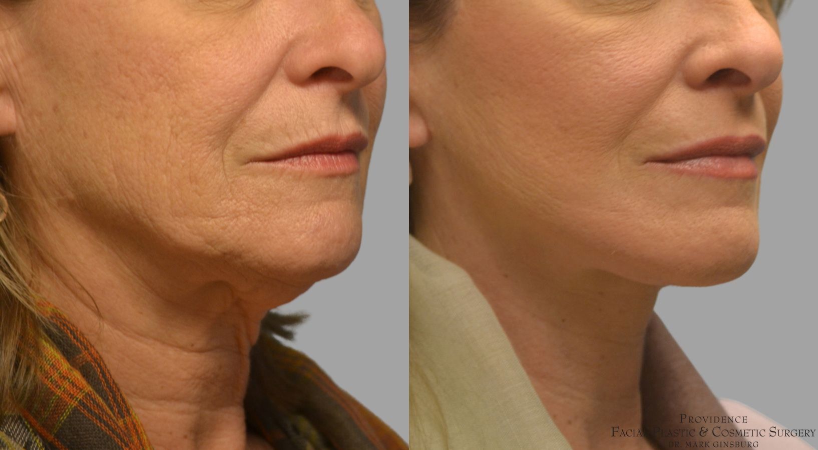 Before and after Facelift case 49952 - Angle 4