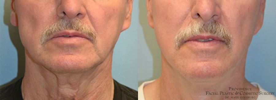 Before and after Facelift case 31649 - Angle 2