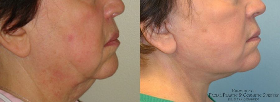 Before and after Facelift case 31645 - Angle 3