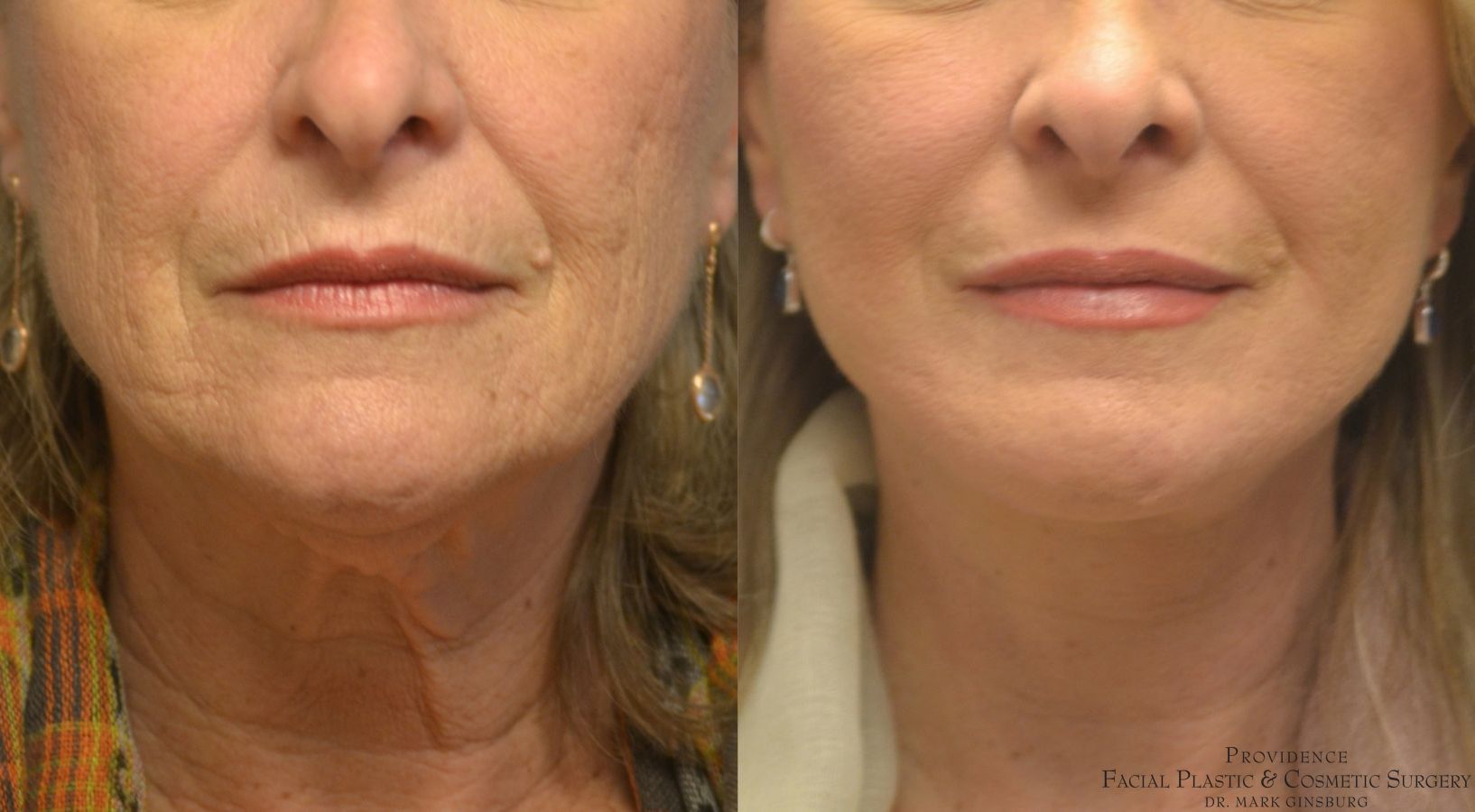Before and after Facelift case 49952 - Angle 3
