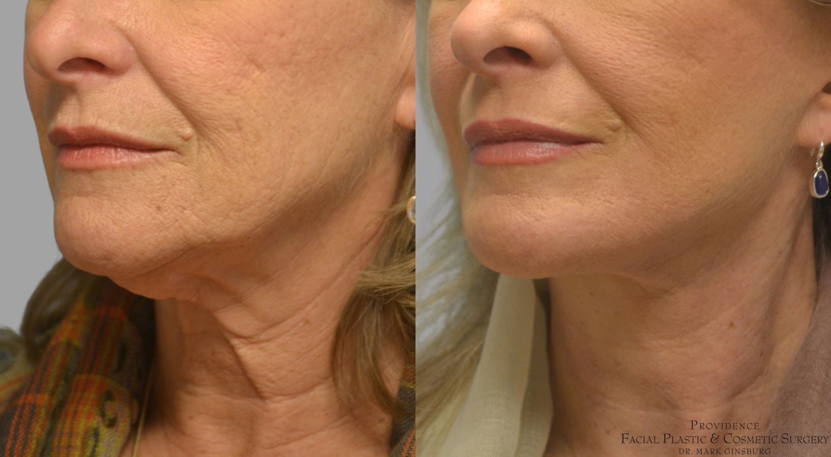 Before and after Facelift case 49952 - Angle 2