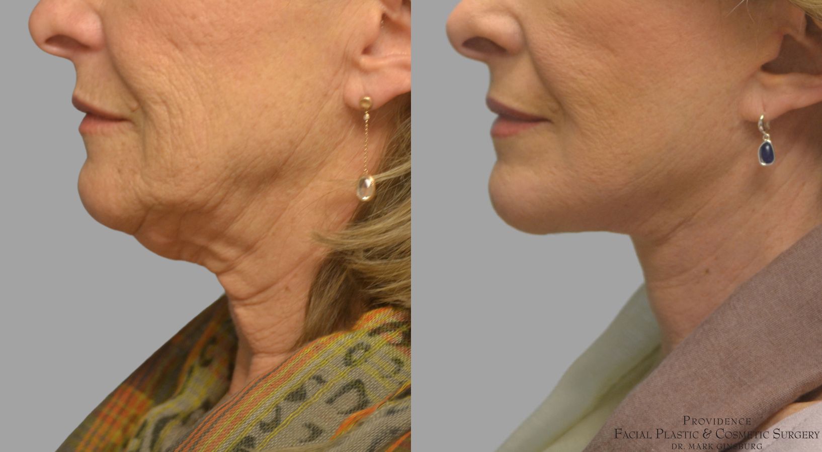 Before and after Facelift case 49952