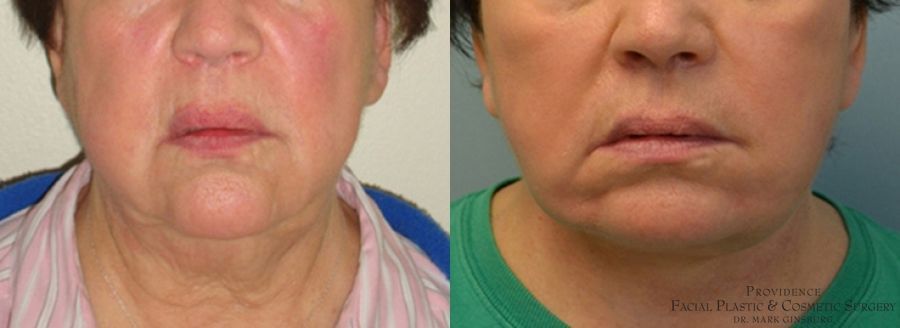 Before and after Facelift case 31645 - Angle 2