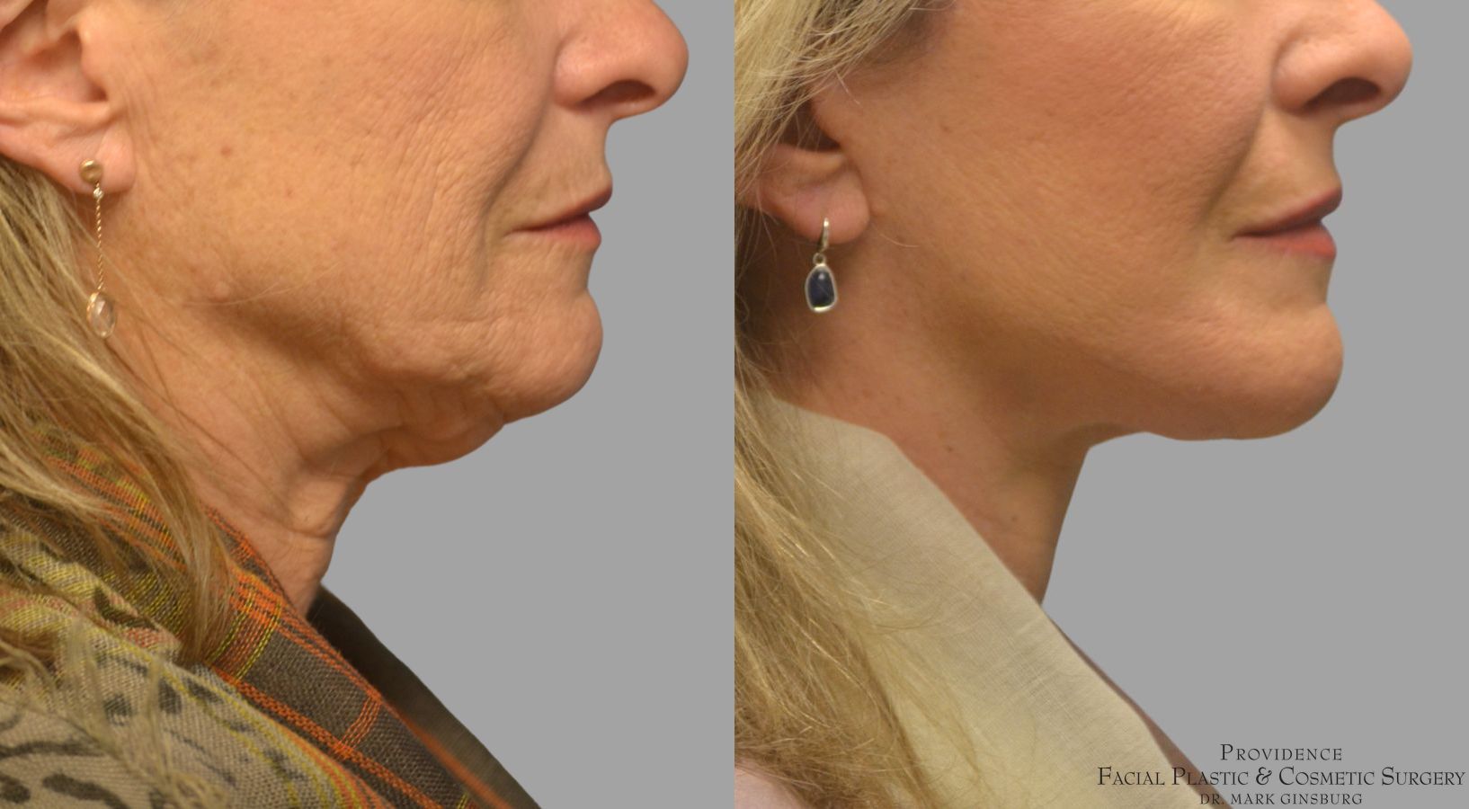 Before and after Facelift case 49952 - Angle 5