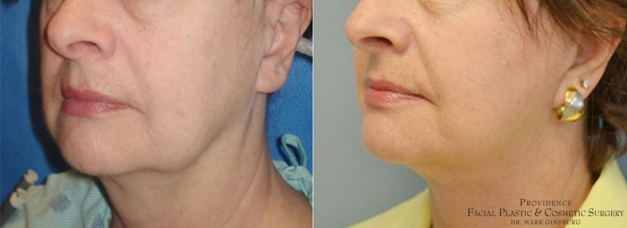 Before and after Facelift case 31648 - Angle 2