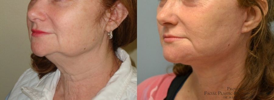 Before and after Facelift case 31650 - Angle 2