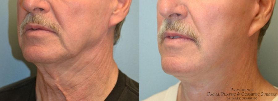 Before and after Facelift case 31649