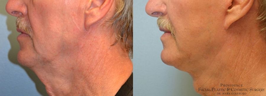 Before and after Facelift case 31649 - Angle 3