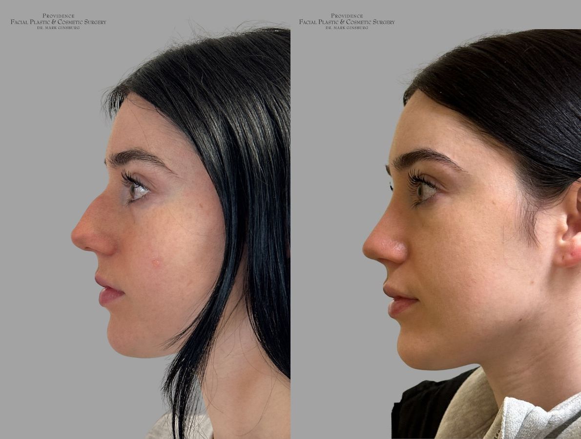 Before and after Primary Rhinoplasty case 31637 - Angle 6
