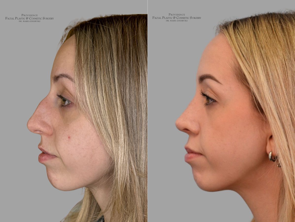 Before and after Primary Rhinoplasty case 31659 - Angle 5