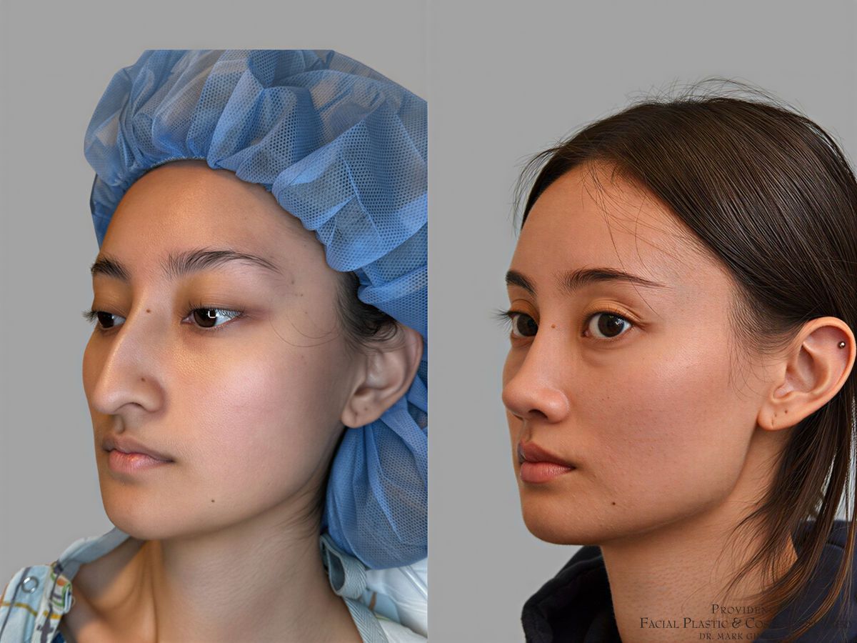 Before and after Primary Rhinoplasty case 31657 - Angle 4