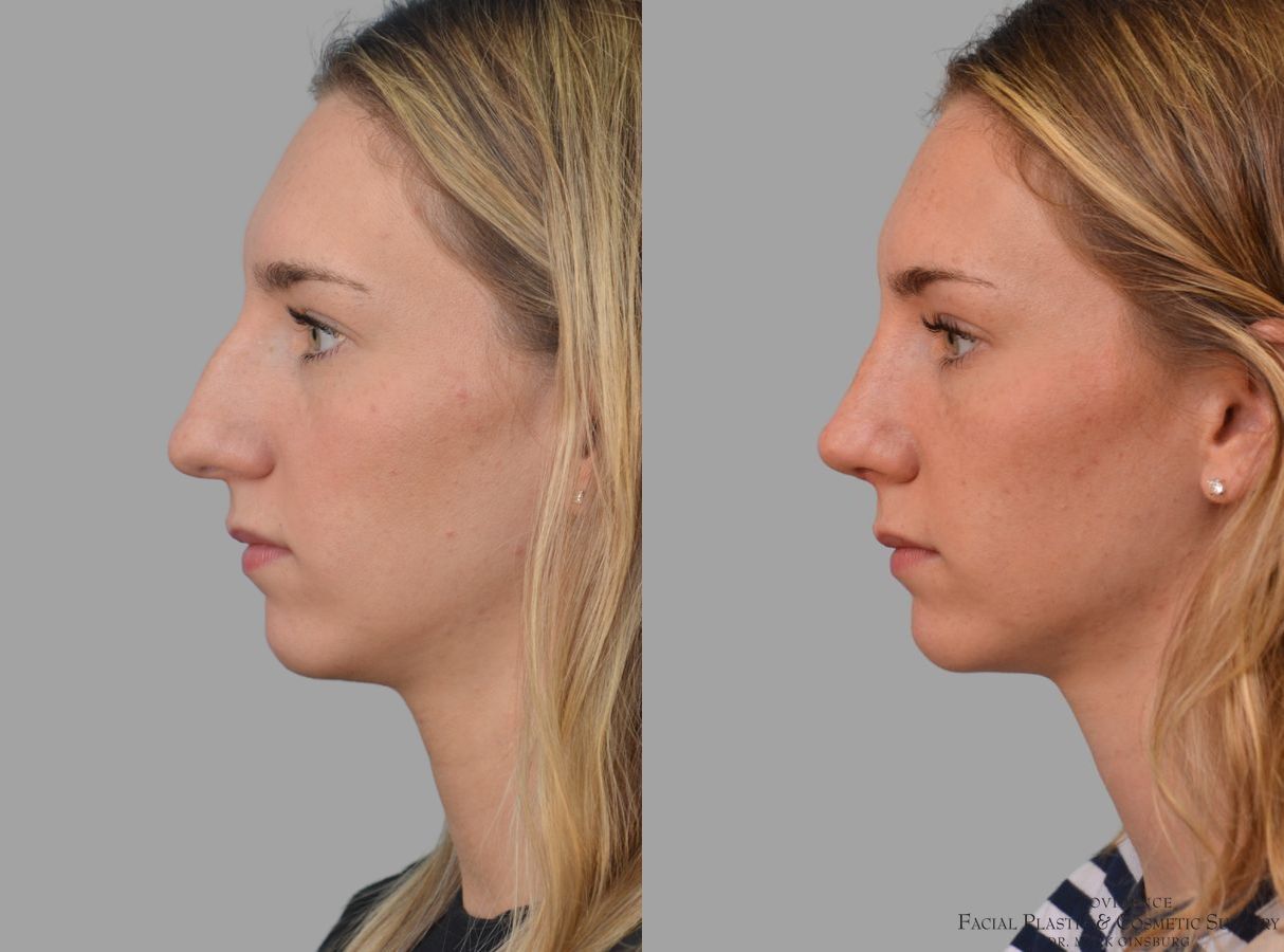 Before and after Primary Rhinoplasty case 43679