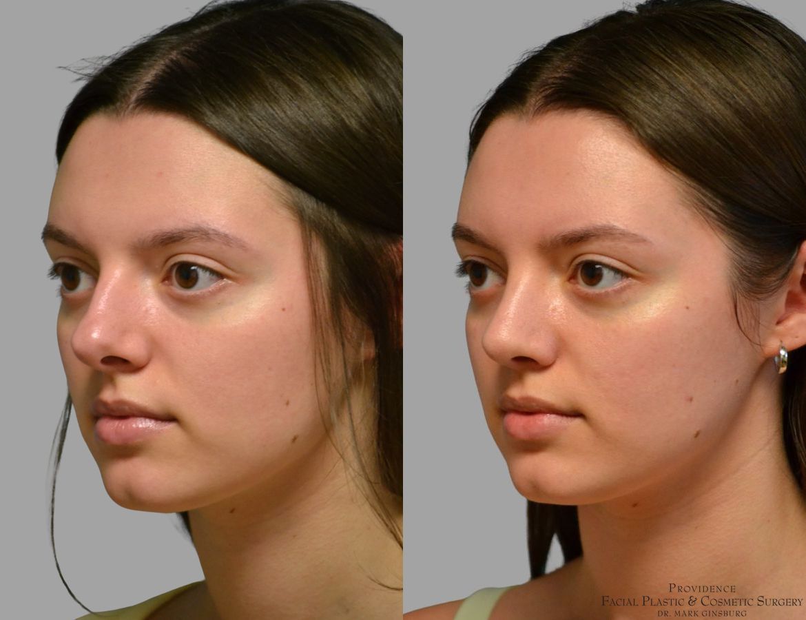 Before and after Primary Rhinoplasty case 49488 - Angle 2