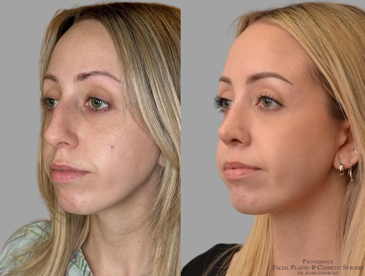 Before and after Thin Skin Rhinoplasty case 31659 - Angle 4