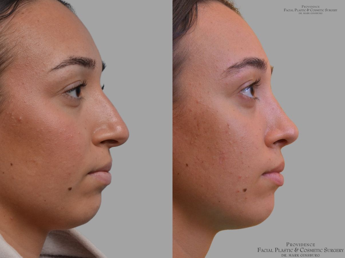 Before and after Primary Rhinoplasty case 49953 - Angle 5