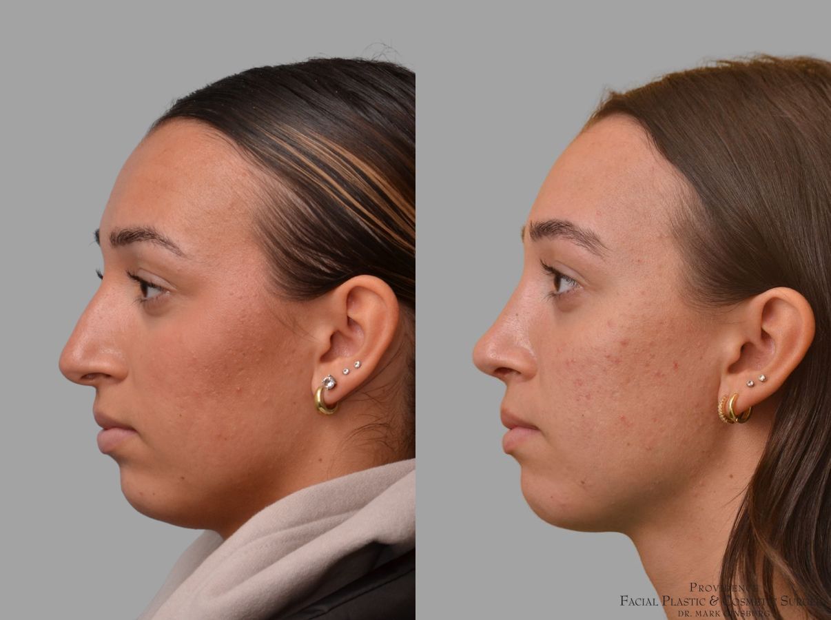 Before and after Primary Rhinoplasty case 49953