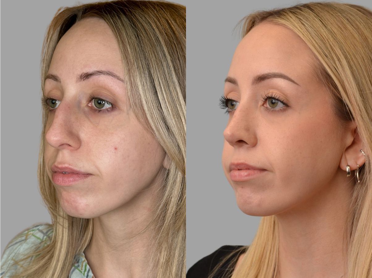 Before and after Primary Rhinoplasty case 31659 - Angle 4