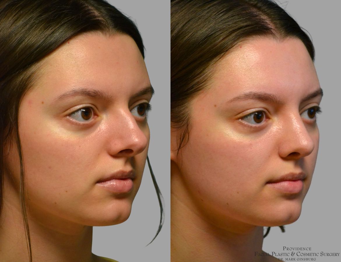 Before and after Primary Rhinoplasty case 49488 - Angle 4