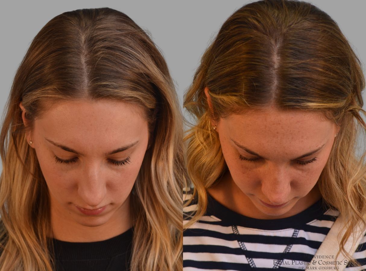 Before and after Primary Rhinoplasty case 43679 - Angle 6
