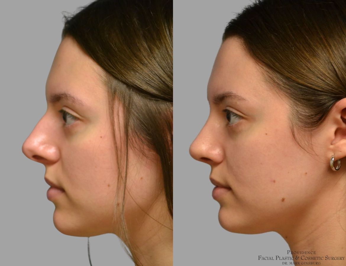 Before and after Primary Rhinoplasty case 49488