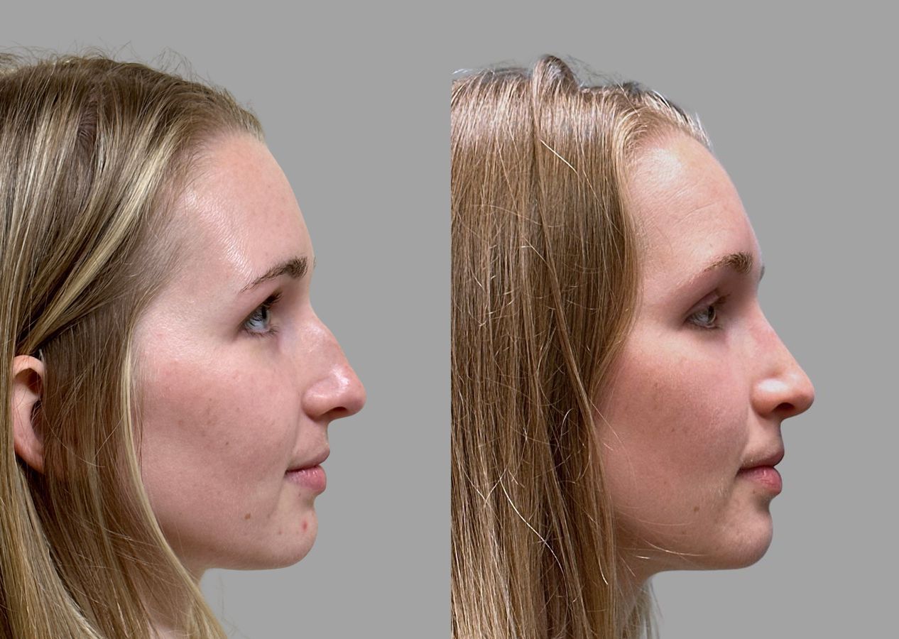 Before and after Primary Rhinoplasty case 31634 - Angle 3