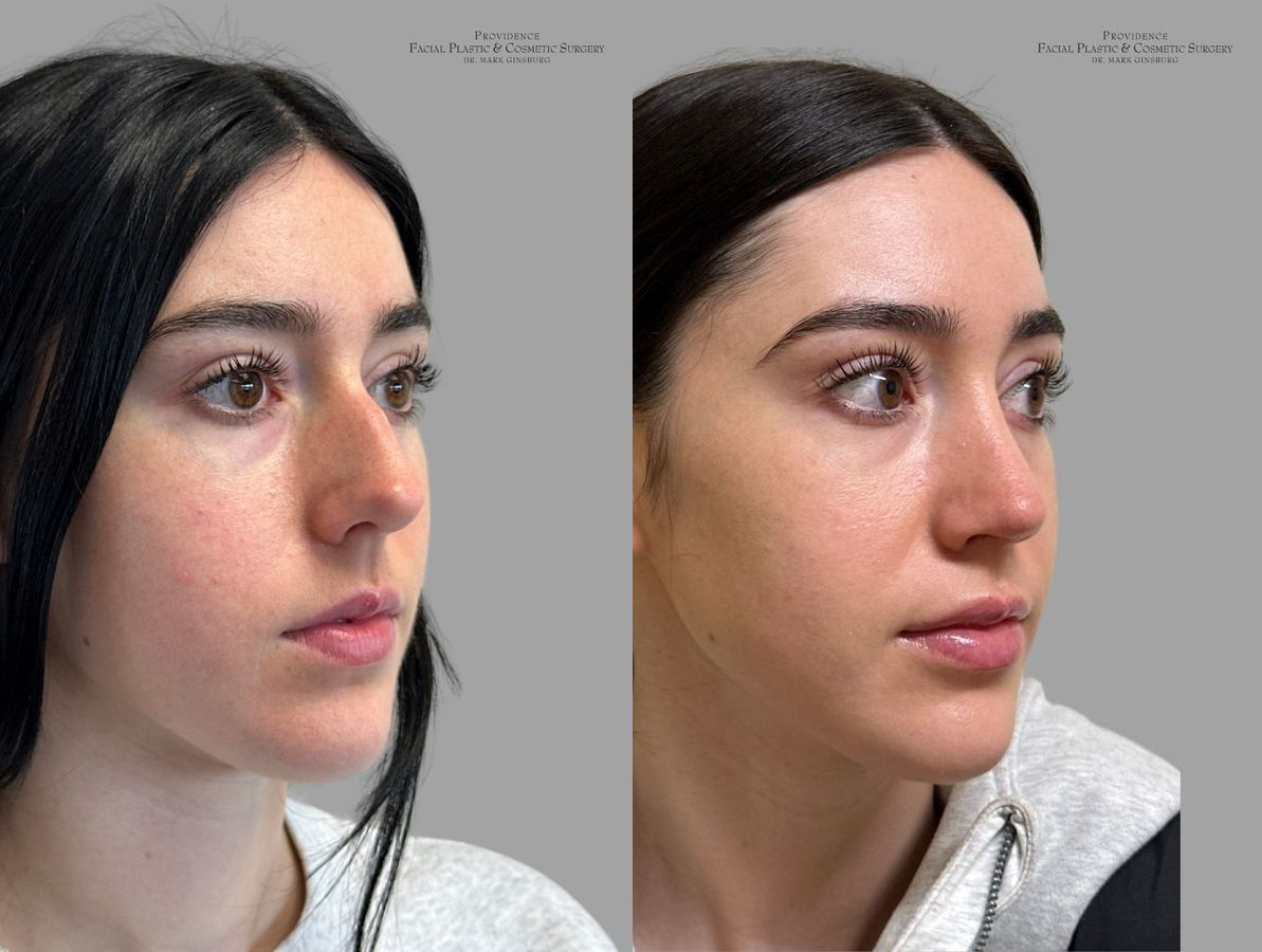 Before and after Primary Rhinoplasty case 31637 - Angle 3