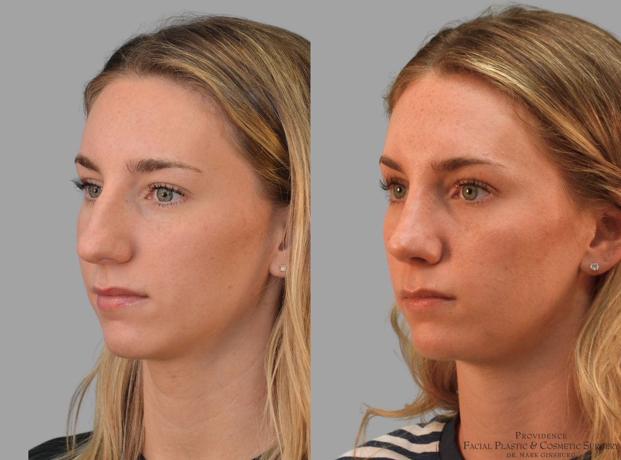 Before and after Primary Rhinoplasty case 43679 - Angle 2