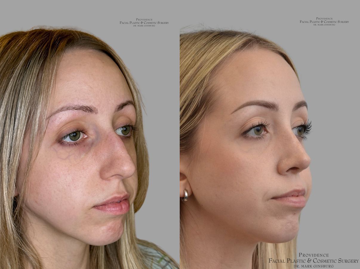Before and after Thin Skin Rhinoplasty case 31659 - Angle 2