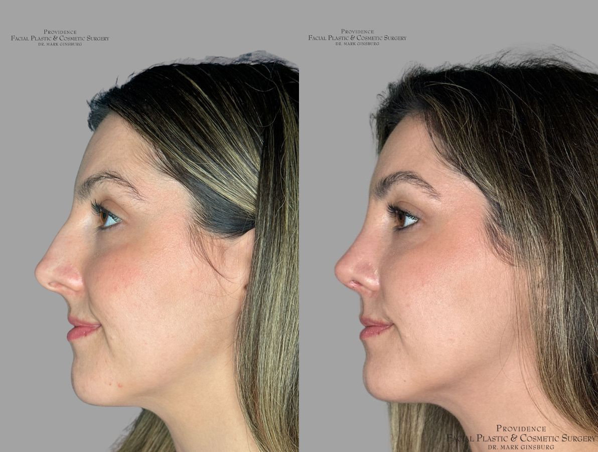 Before and after Primary Rhinoplasty case 31639 - Angle 5