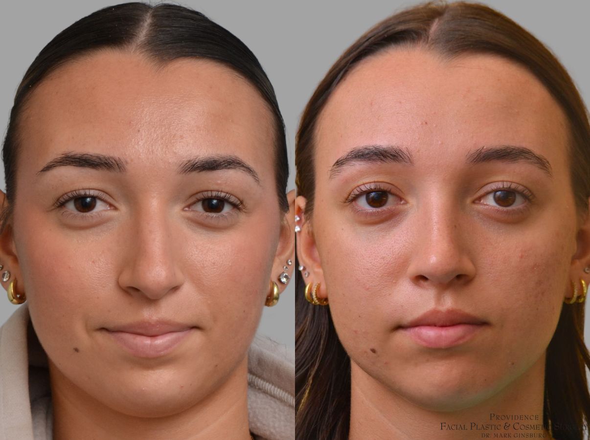 Before and after Primary Rhinoplasty case 49953 - Angle 3