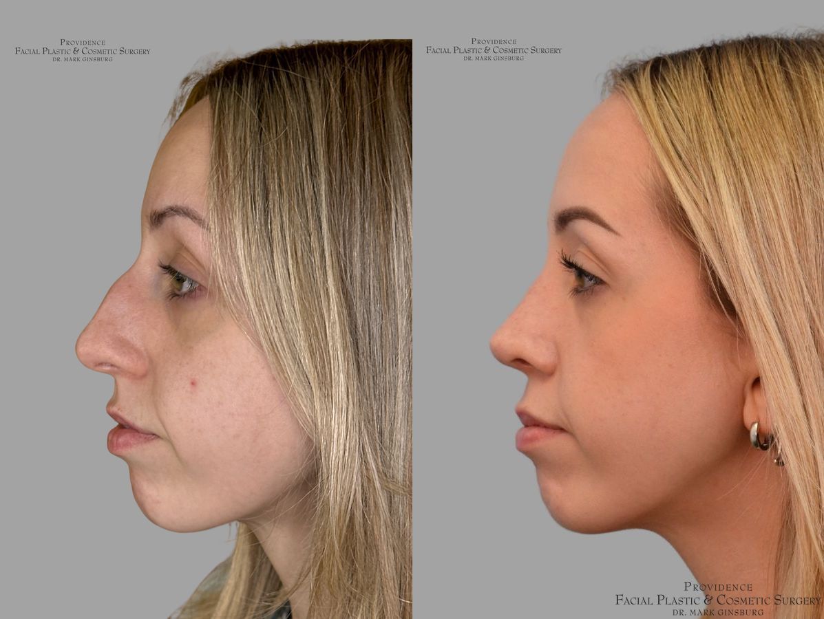 Before and after Thin Skin Rhinoplasty case 31659 - Angle 5