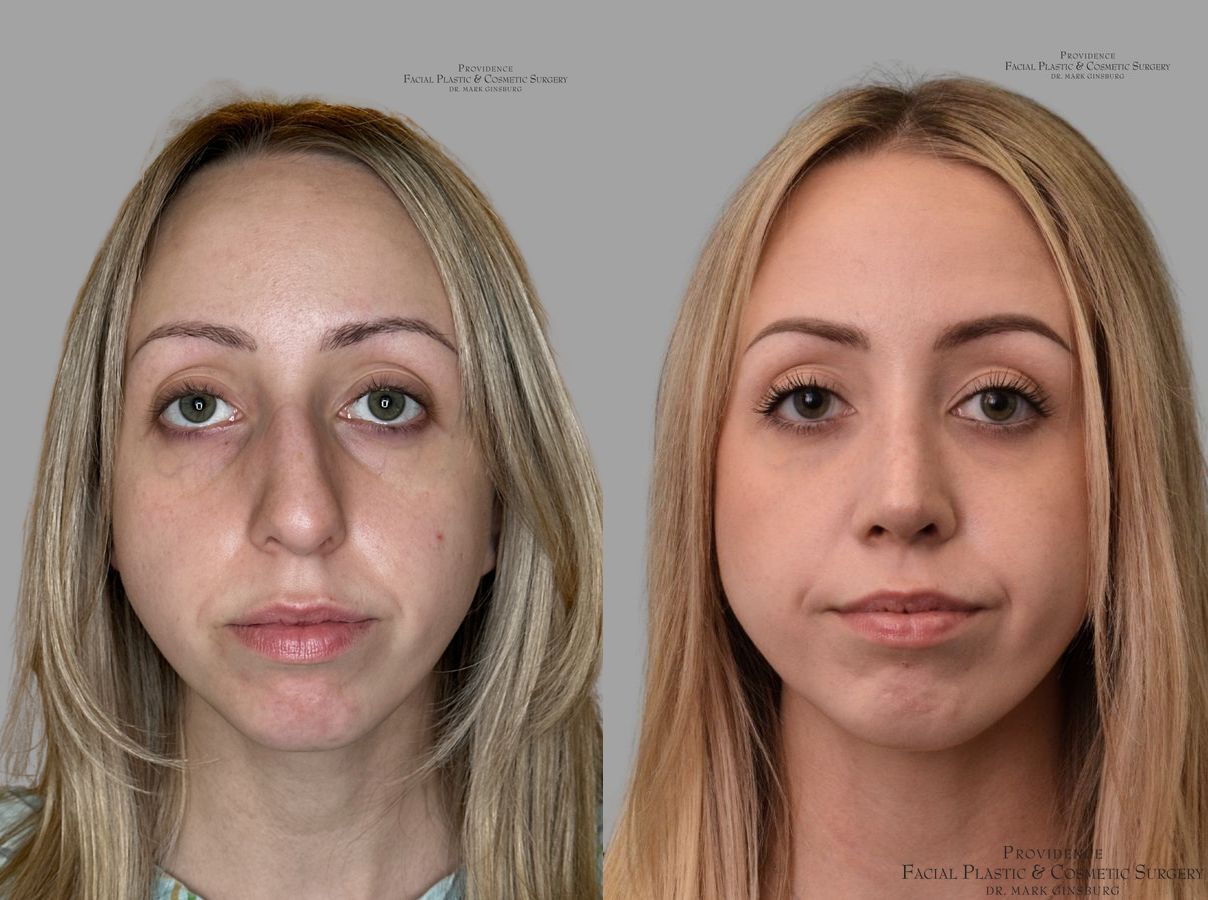 Before and after Thin Skin Rhinoplasty case 31659